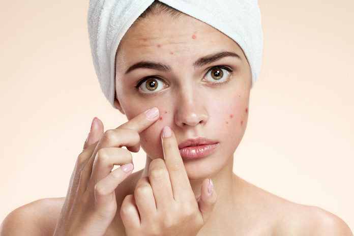 What Causes Acne What Causes Acne